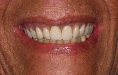 Smile gallary image - After